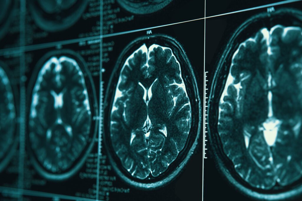 3 Reasons You Need an Attorney for a Brain Injury Claim