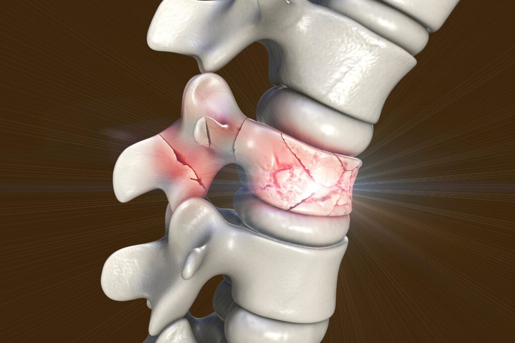 The Role of Expert Witnesses in Spinal Cord Injury Cases